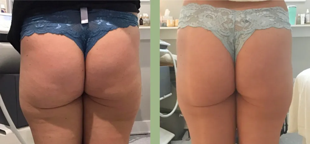 Cryo T-Shock - 5 Treatments in 60 days - Only $1695 (Limited Time Offer) w/Lumens device