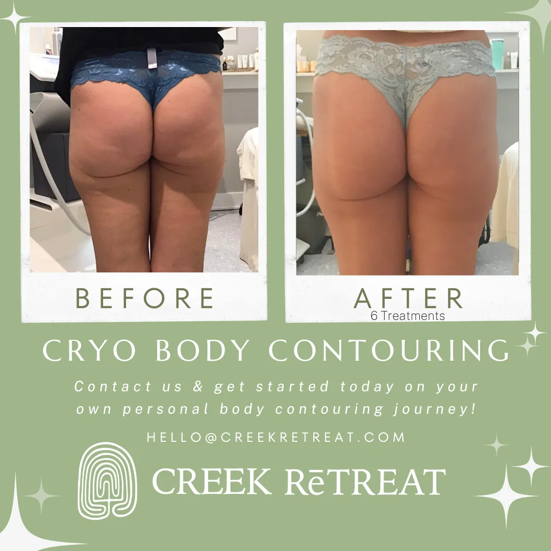 Cryo T-Shock - 5 Treatments in 60 days - Only $1695 (Limited Time Offer) w/Lumens device