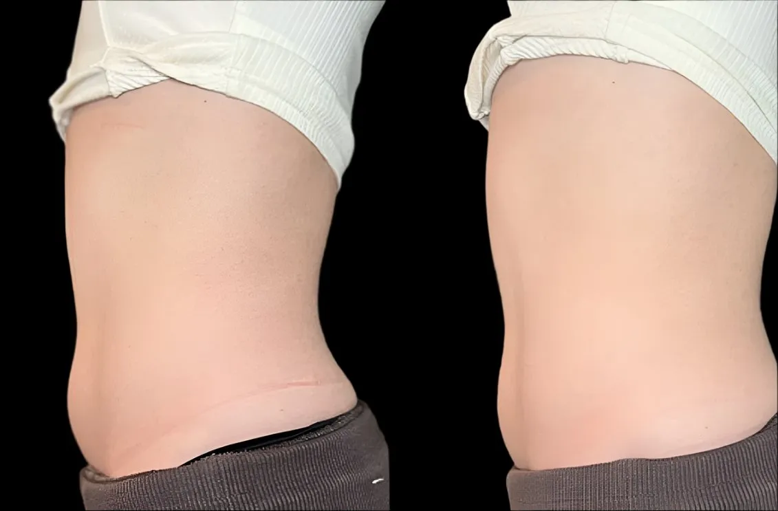 Cryo T-Shock - 5 Treatments in 60 days - Only $1695 (Limited Time Offer) w/Lumens device
